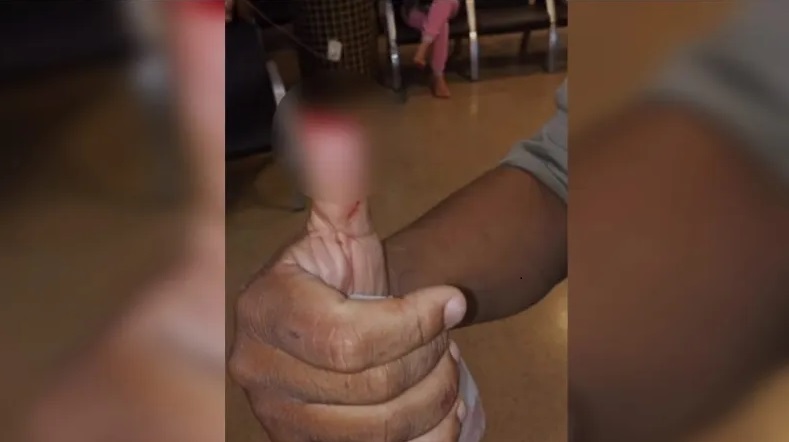 mulher-arranca-parte-do-dedo-polegar-de-policial-com-mordida-durante-abordagem